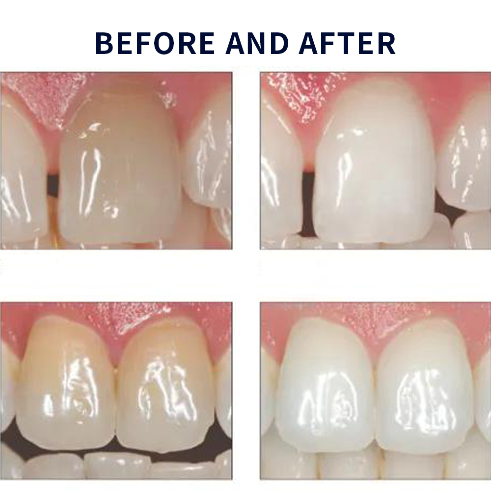 20% pF 20 16ชุดเจล8x1.2มล. ชุด - Teeth Whitening Led Kit บทวิจารณ์และราคา