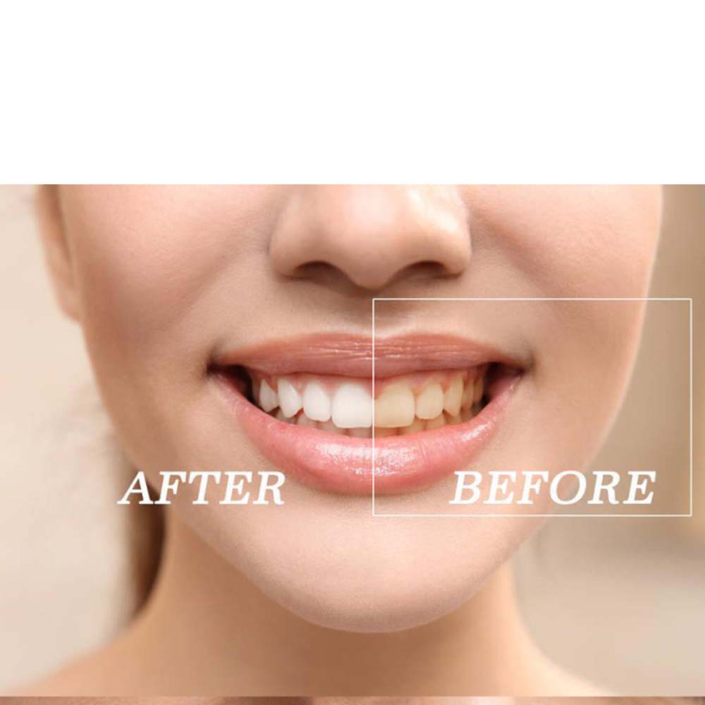 ชุดเจลฟอกสีฟอกสีฟันเปอร์ออกไซด - Teeth Whitening Led Kit บทวิจารณ์และราคา