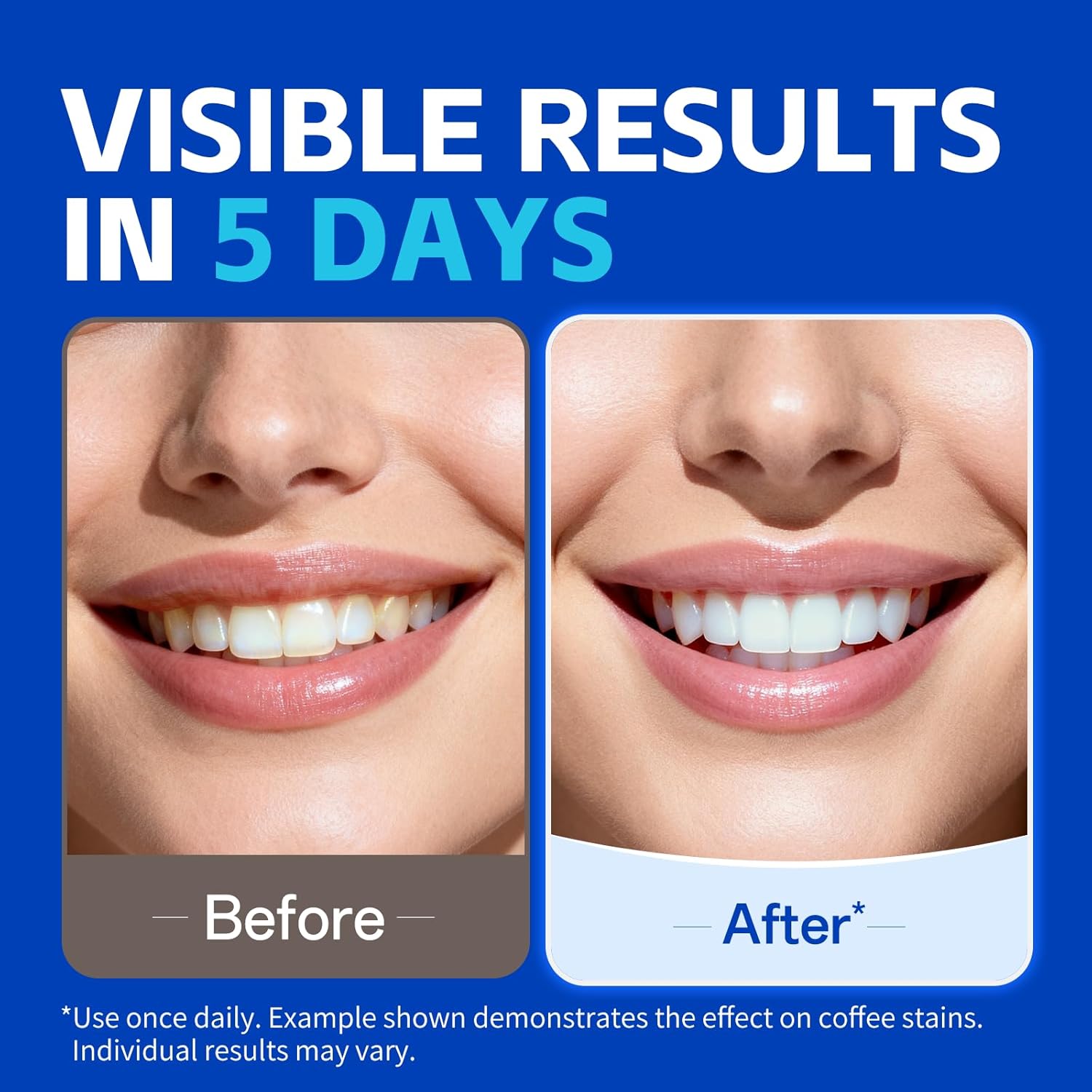 แผ่นฟอกฟันขาว 1/7 คู่ เพื่อรอย - Teeth Whitening Strips Permanent บทวิจารณ์และราคา