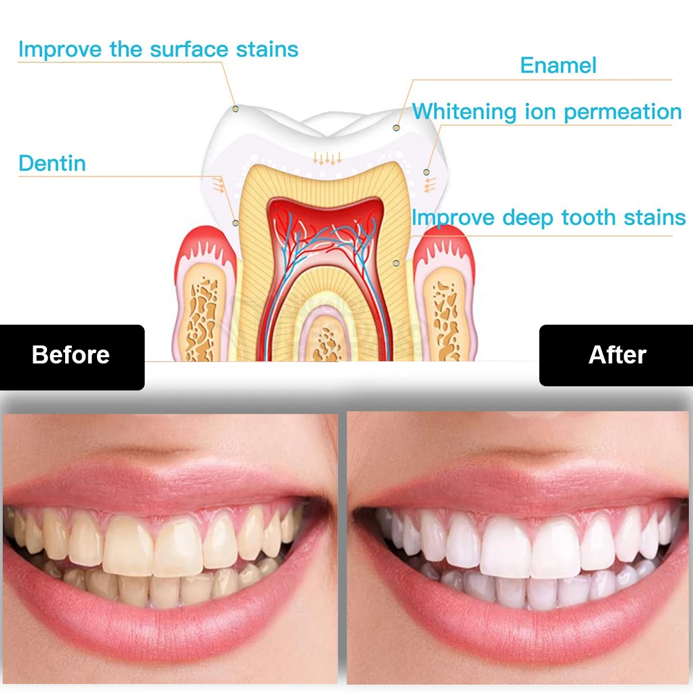ทันตกรรมชุดฟอกสีฟัน Mini 16 LE - Teeth Whitening Led Kit บทวิจารณ์และราคา